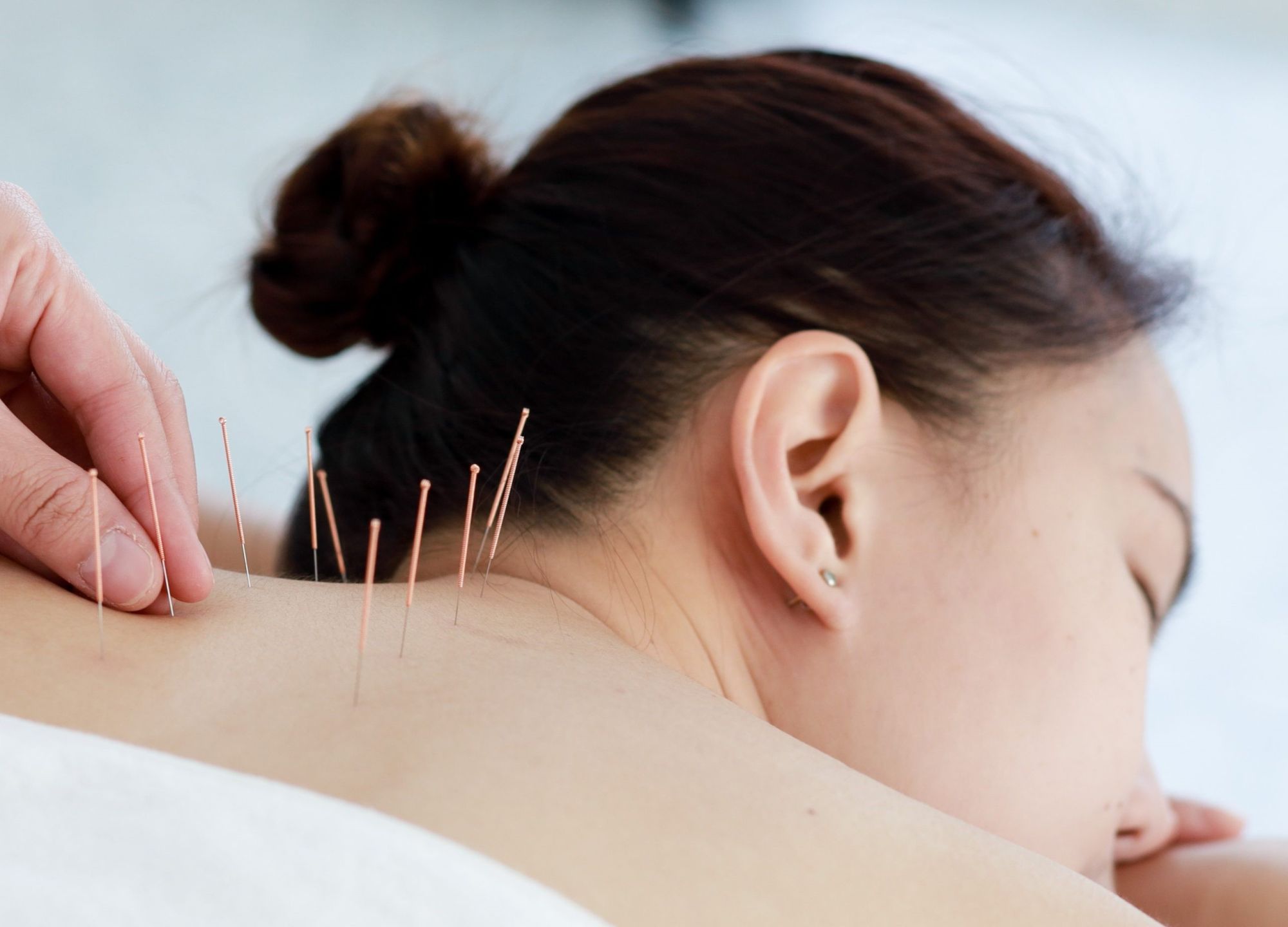 Иглорефлексотерапия в МЦ Норма